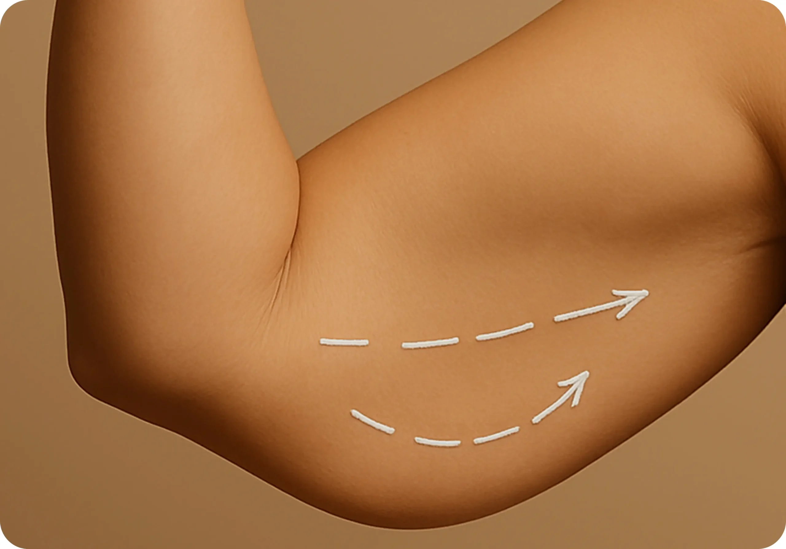 شد أو شفط الذراعين