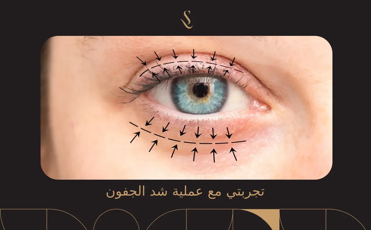 تجربتي مع عملية شد الجفون