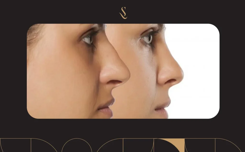 تعليمات بعد عملية تجميل الأنف