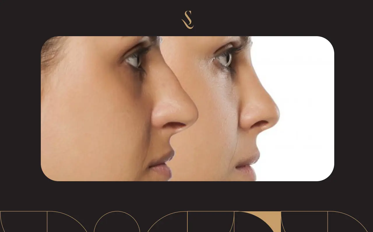 تعليمات بعد عملية تجميل الأنف