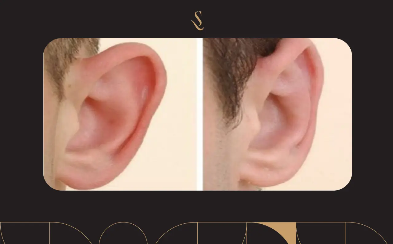 Ear Cosmetic Surgery